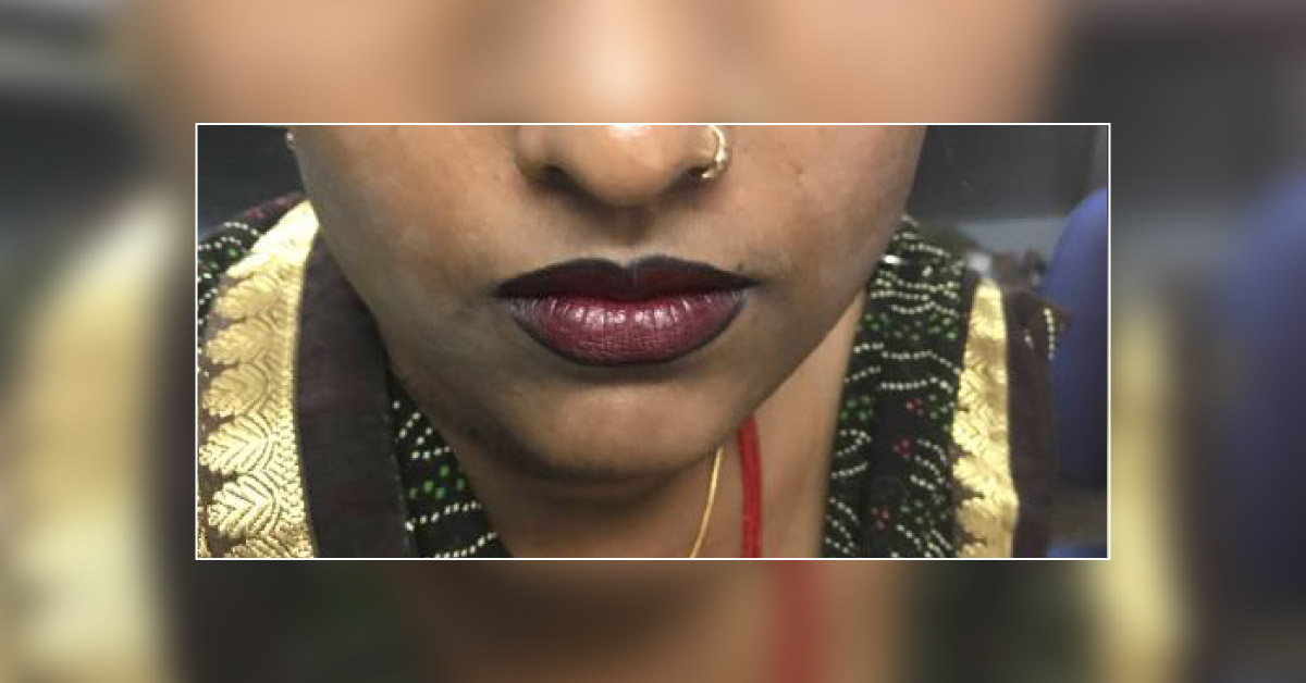 Identify Skin Lesion On Face?