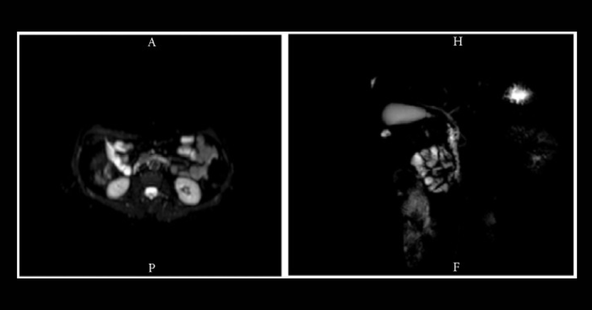 A Post-menopausal Woman with a History of Endometriosis