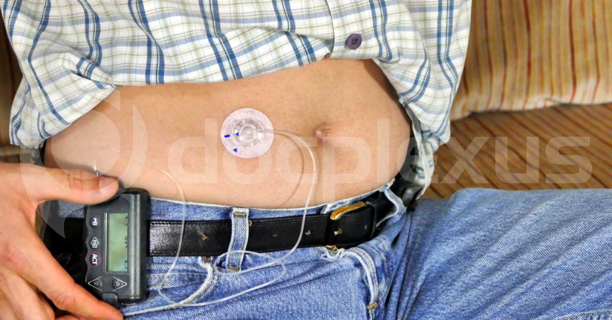 Artificial Pancreas Improves Glycaemic Control, Without Increased Hypoglycaemia In T2D