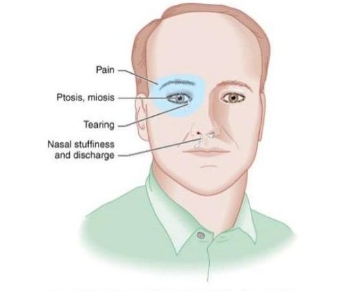 Brief Review On Horner’s Syndrome