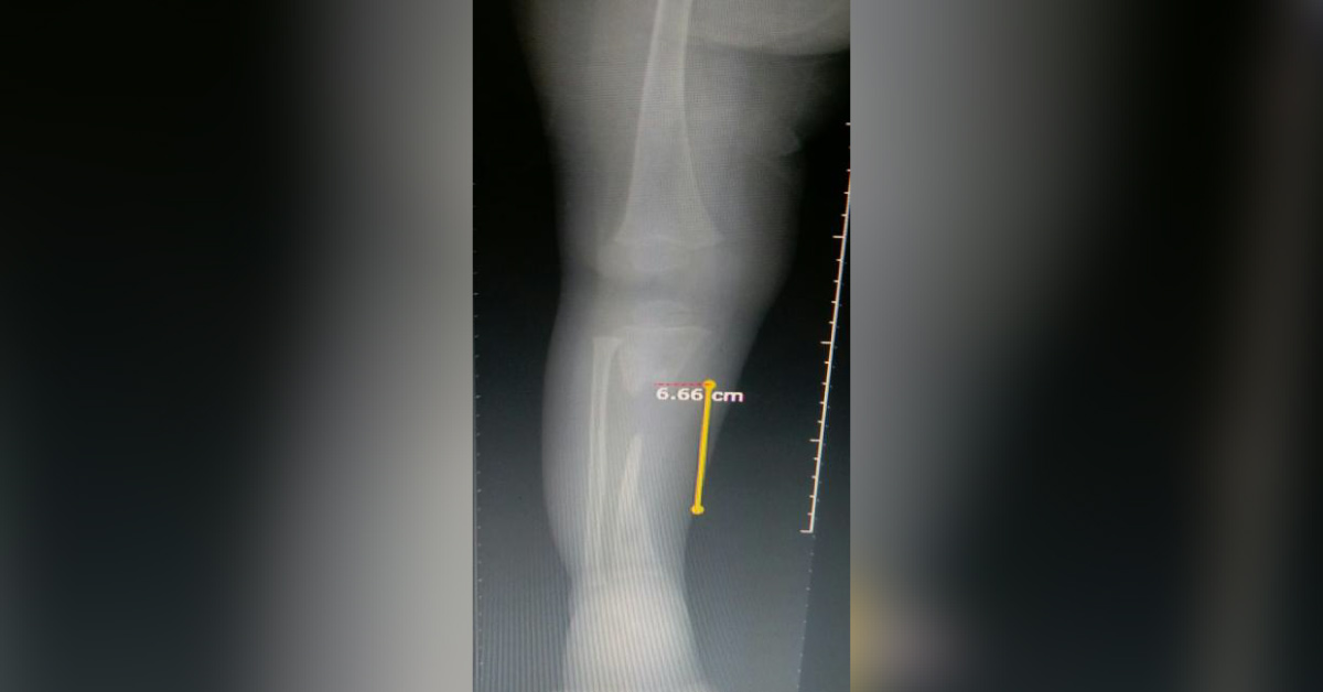 Case Of Gap Nonunion
