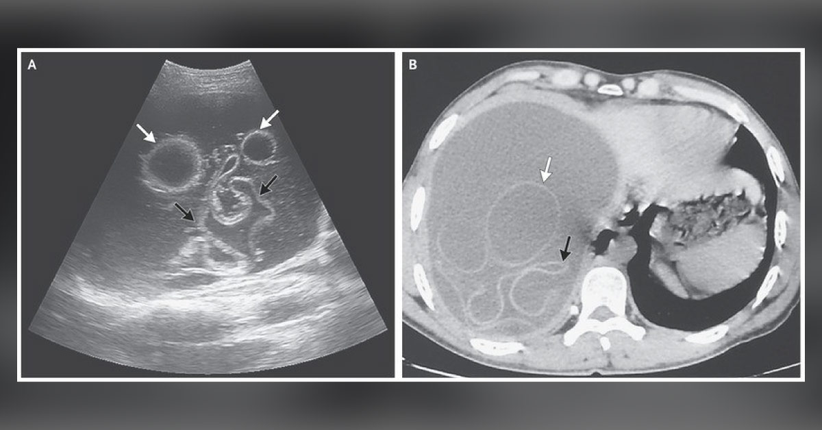 Hepatomegaly with a Palpable Hepatic Mass — What's your Diagnosis?