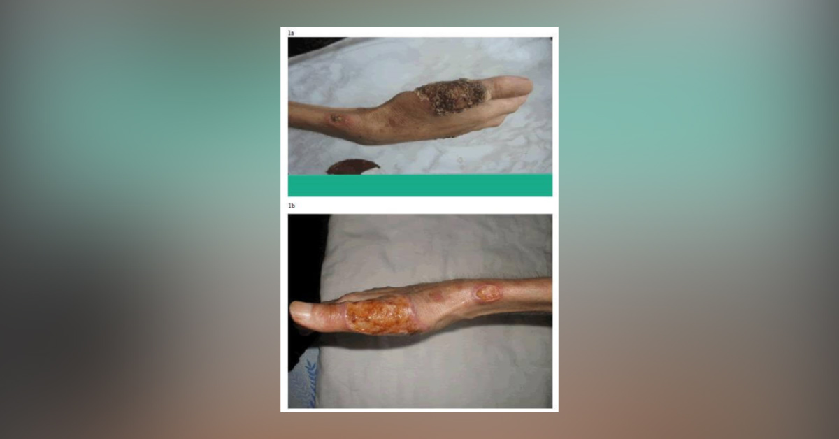 Can You Identify This Lesion In A HIV-Positive Patient