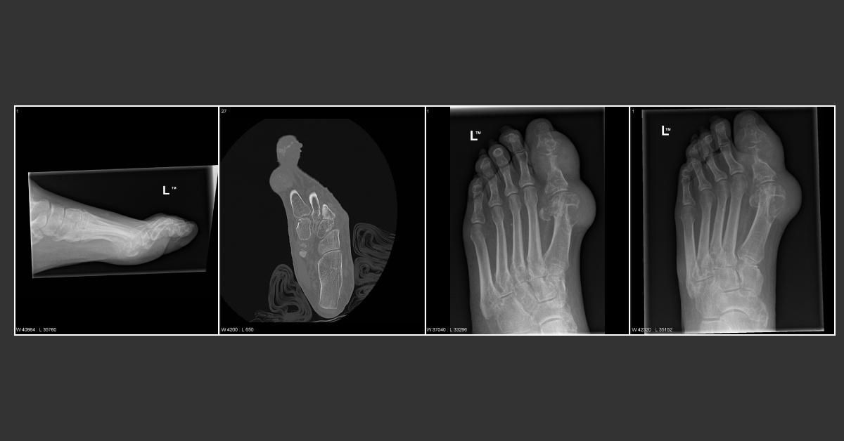 Which Type Of Gout Is This?