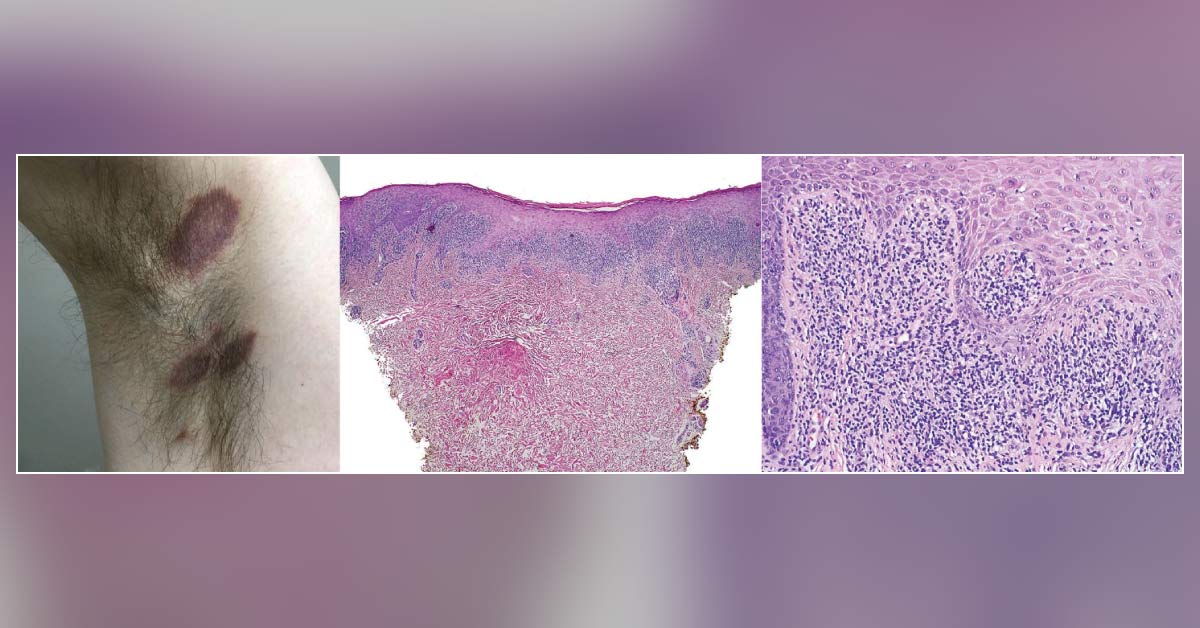 Violaceous Patches in the Axilla
