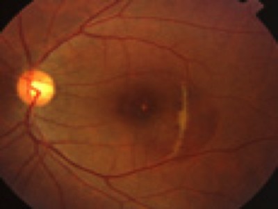 A Patient With The Fundus Lesion