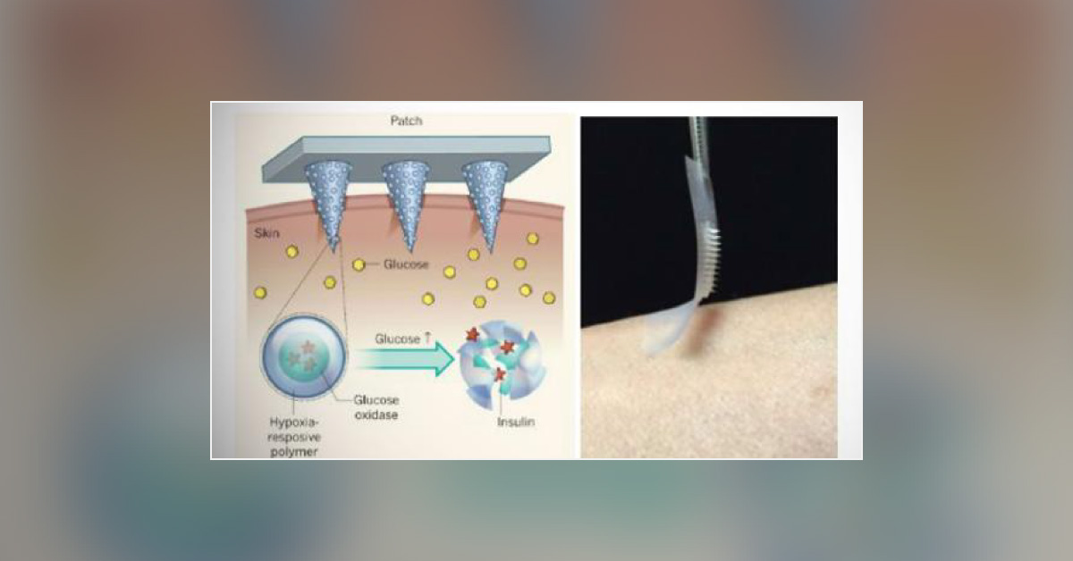 Insulin Patch: Future
