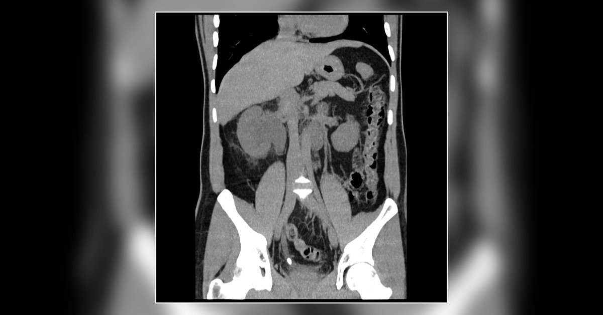 A Man With Loin Pain
