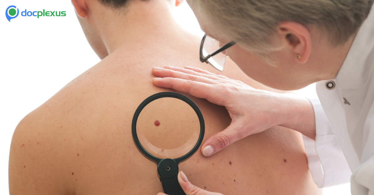 Melanoma A Metastatic Skin Cancer Can Be Early Detected By A Blood Test