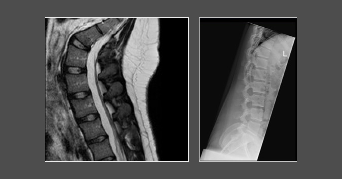 A Girl with Chronic Back Pain