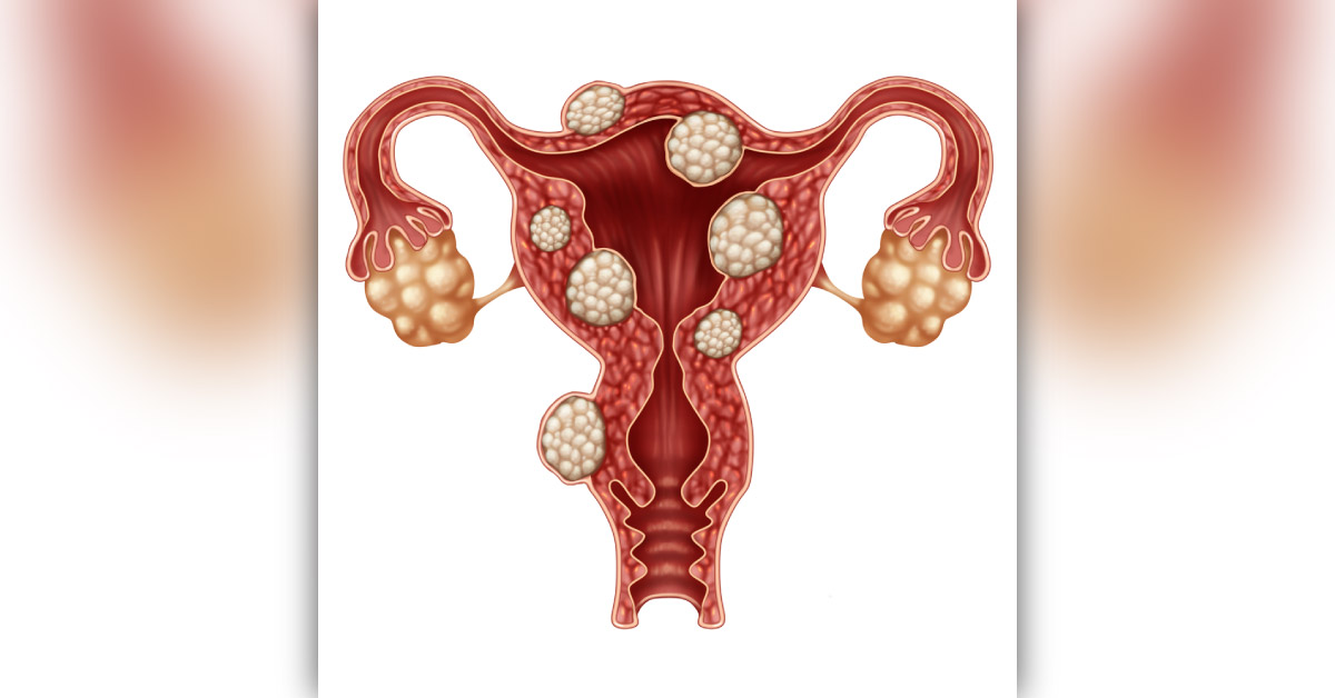 Uterine Fibroids Leading to Recurrent Abortions