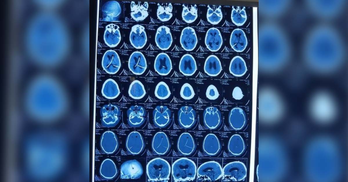 Suprasellar Sol With Hydrocephalus