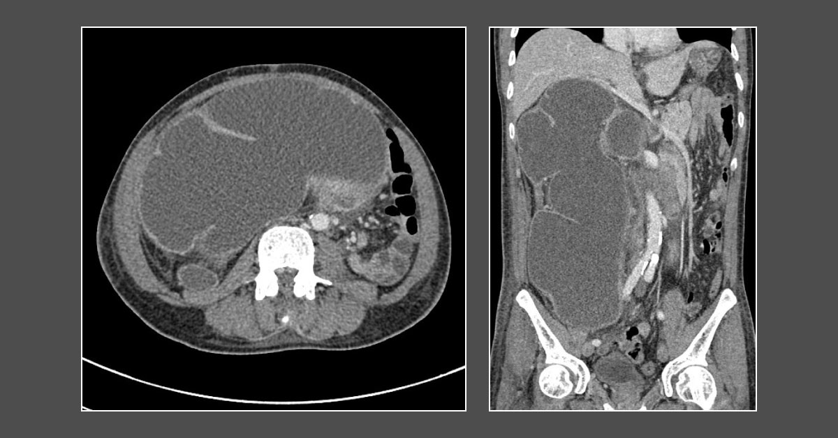 Find Abnormality In Right Kidney?
