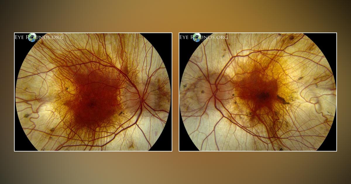 Can You Identify This Ophthalmic Disorder?
