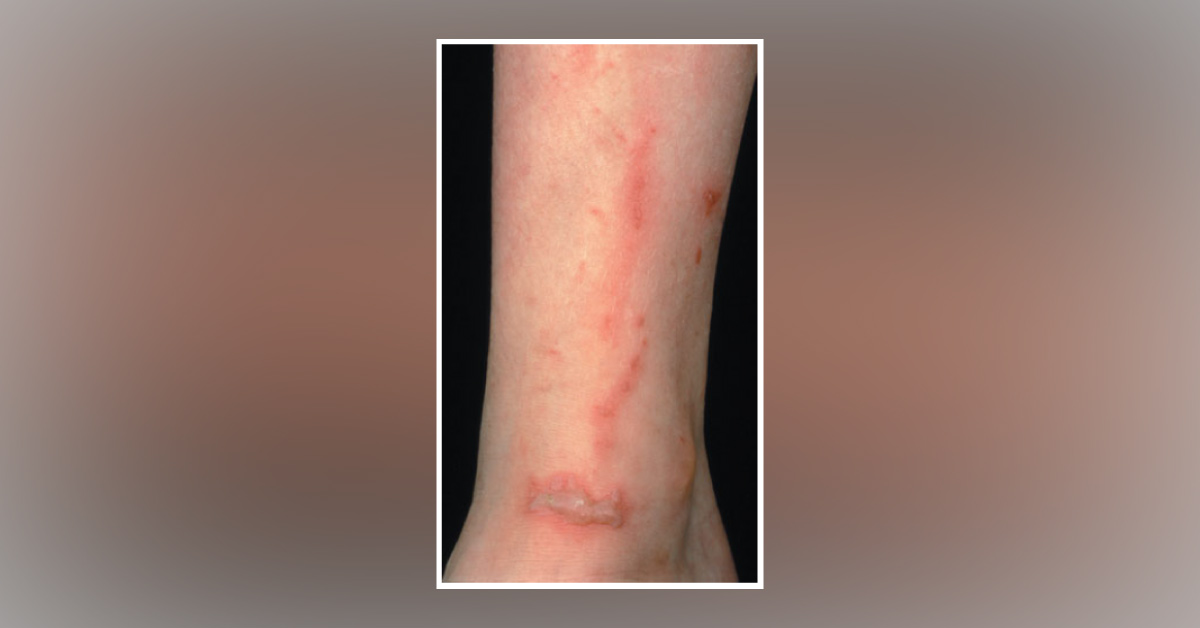 Acute Onset Linear Blistering On The Legs