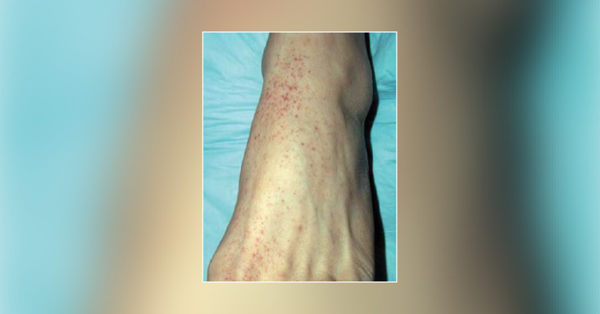Petechial Rash in a Girl