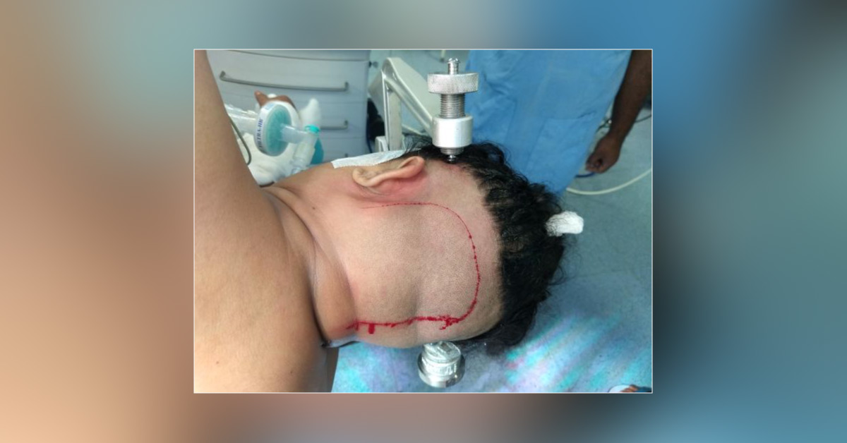 Case Of Foramen Magnum Maningeoma