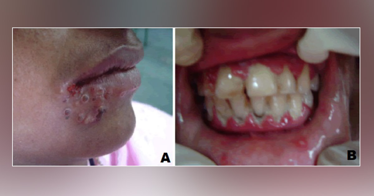 Recurrent Blisters And Ulcerations In Pregnancy