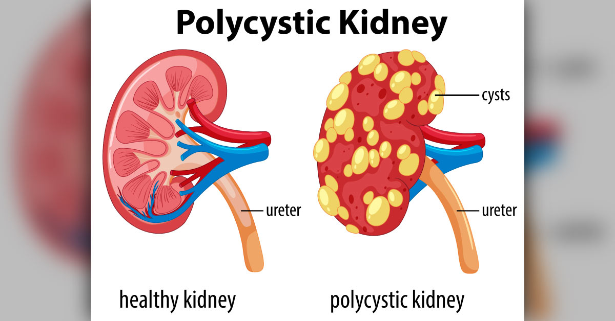 Tolvaptan Delays The Onset Of End-stage Renal Disease In A Polycystic Kidney Disease