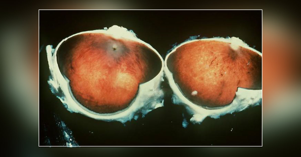 Brief Review On The Associations Of Retinitis Pigmentosa