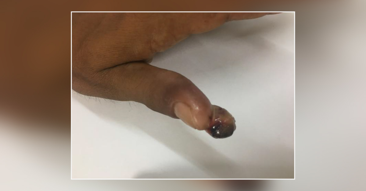 Case Of Swelling On Thumb