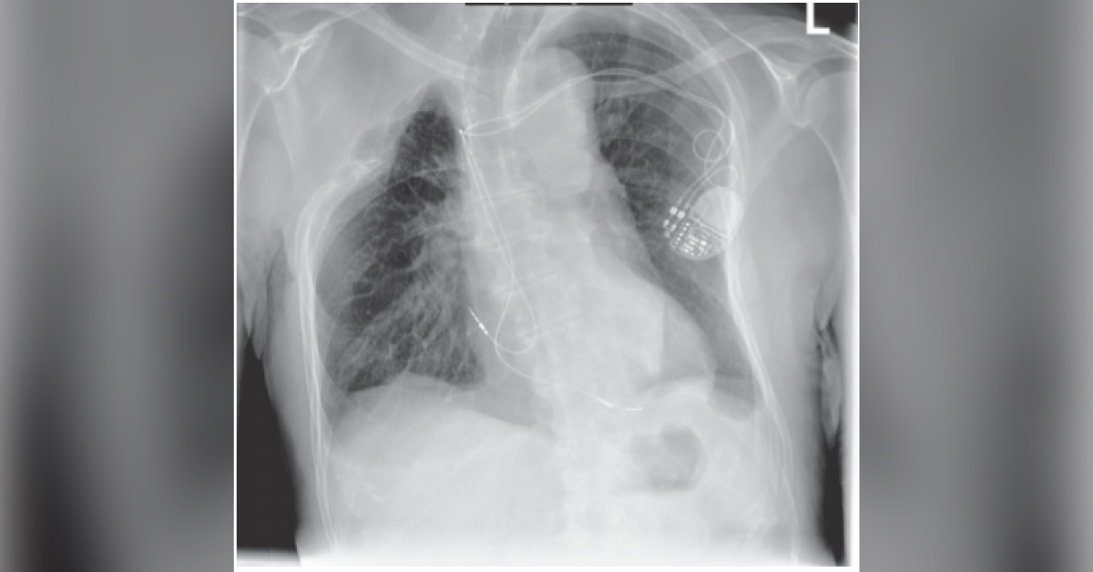 Chest Wall Deformity in a Pacemaker Patient