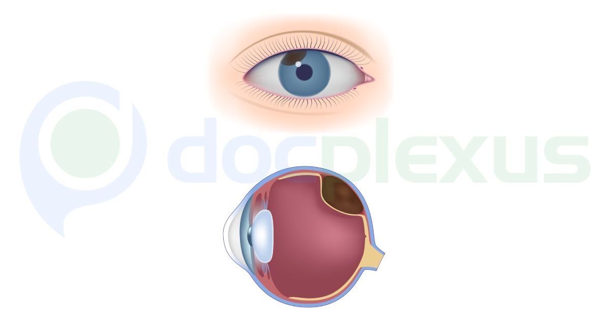 Brief Review On The Difficulties In Diagnosis Of Choroid Melanoma