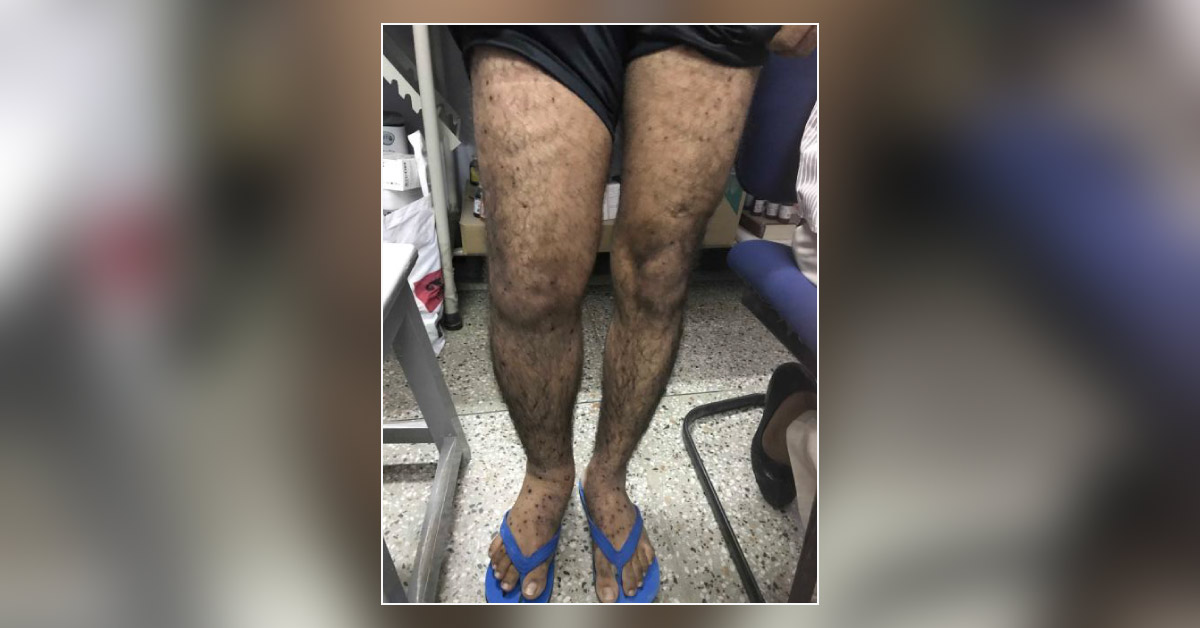 Post Chicken Pox Complication Due To DVT