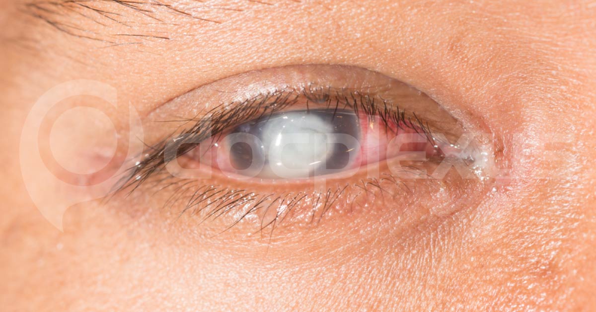 Brief Review On Ocular Manifestations Of Different Viruses