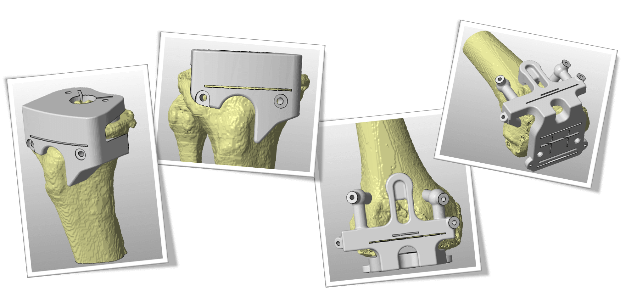 Patient Specific Templates (PST) For Total Knee Replacement