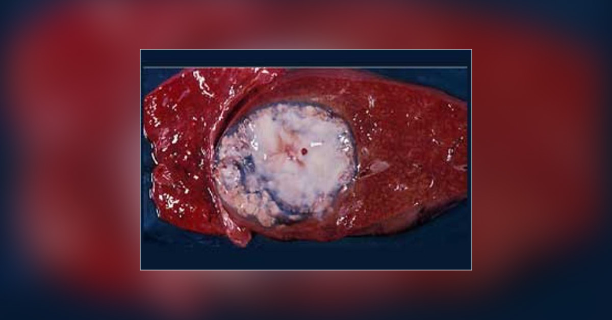 Tinidazole Better Than Metronidazole For Amoebic Liver Abscess
