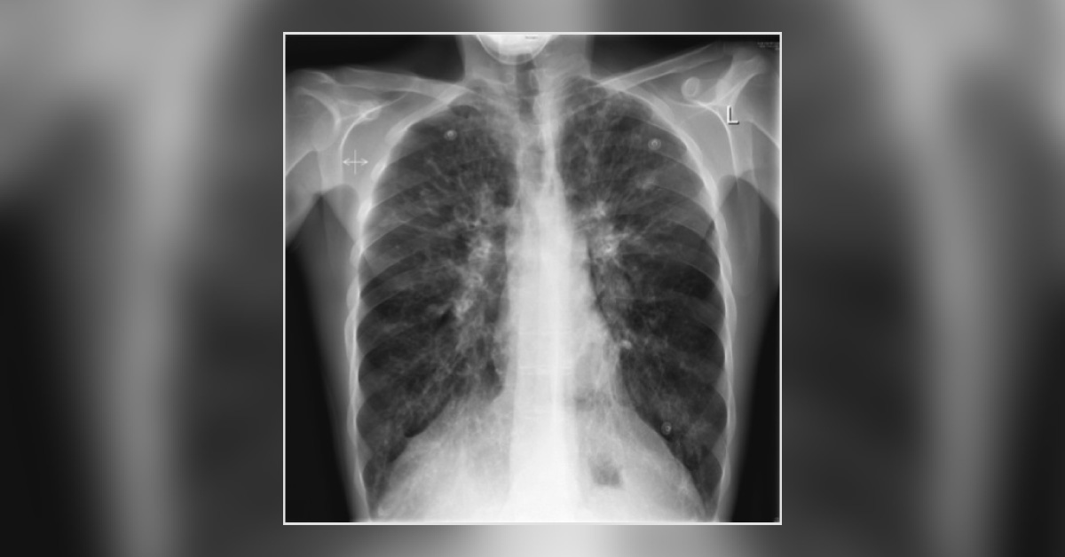 A Boy With Chronic Cough