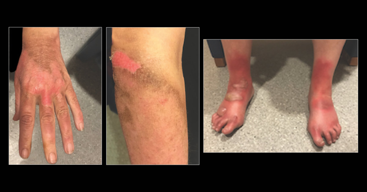 Case of a Woman with Pruritic Erythema