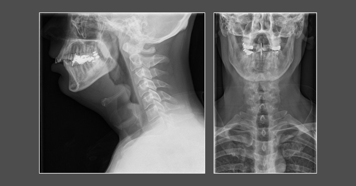 Why This Woman With Odynophagia symptoms?