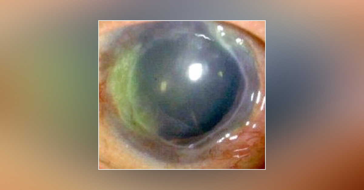 Brief Review On Mooren's Ulcer