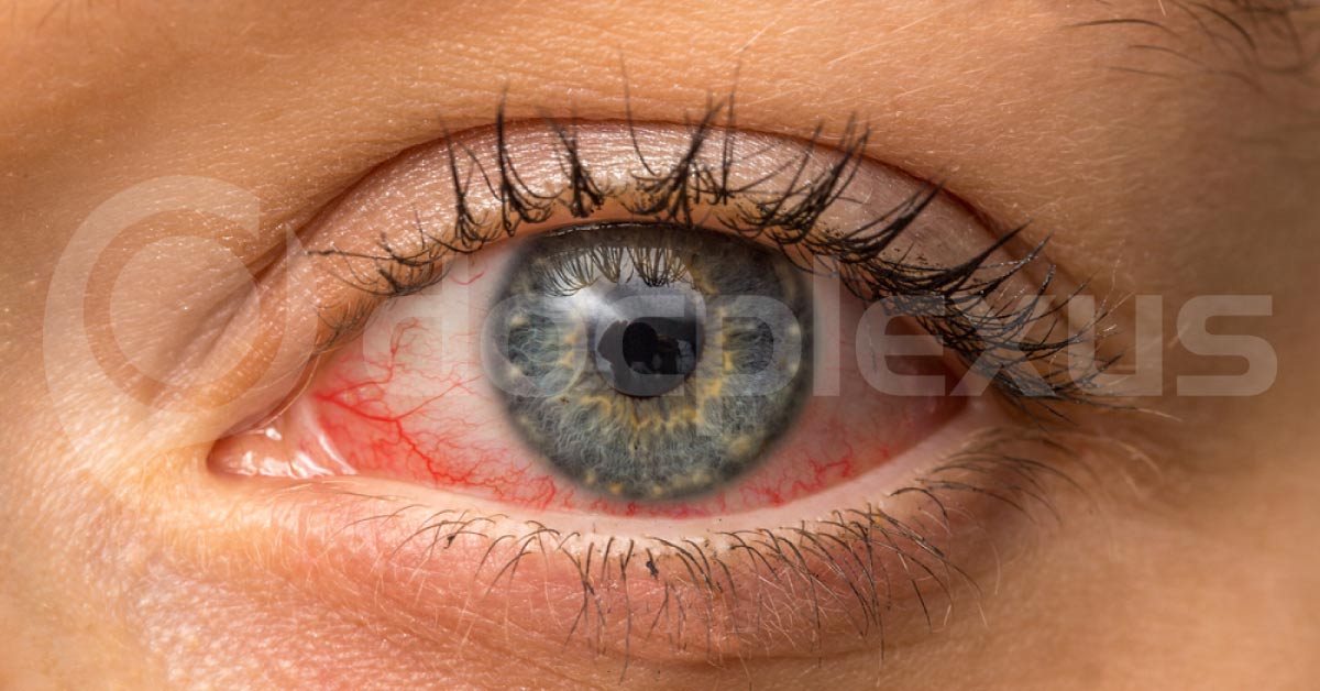 Brief Review On Ocular Manifestations Of Xeroderma Pigmentosum