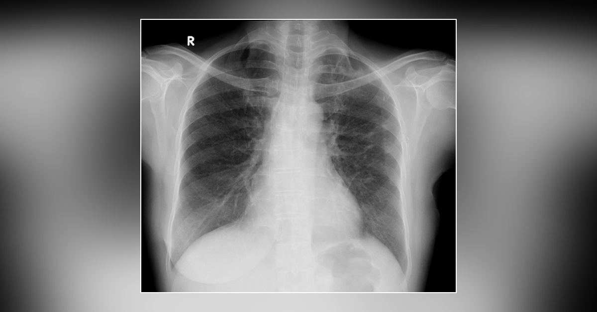 Case of Cough and Breathlessness in a Breast Cancer Patient