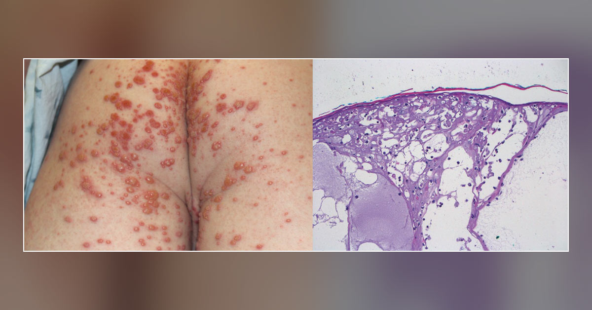 Blistering Rashes In A Child