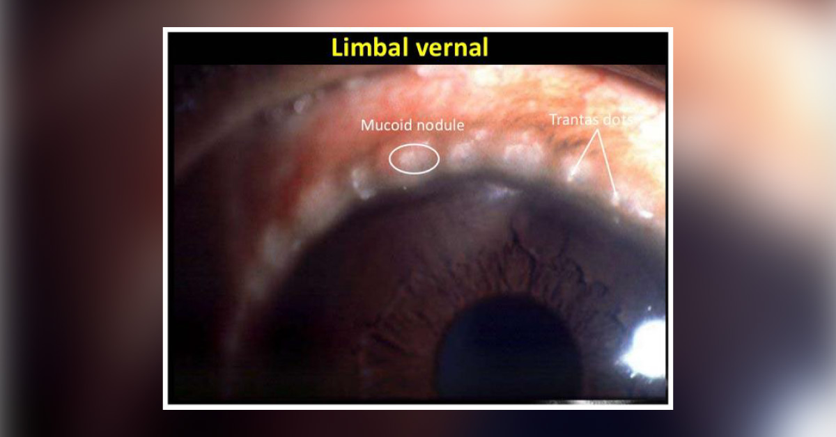 Brief Review On Relations Of Corneal Dystrophy With Vernal Keratoconjunctivitis