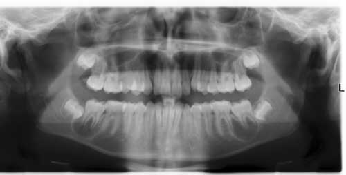 A Boy With Swelling In Jaw