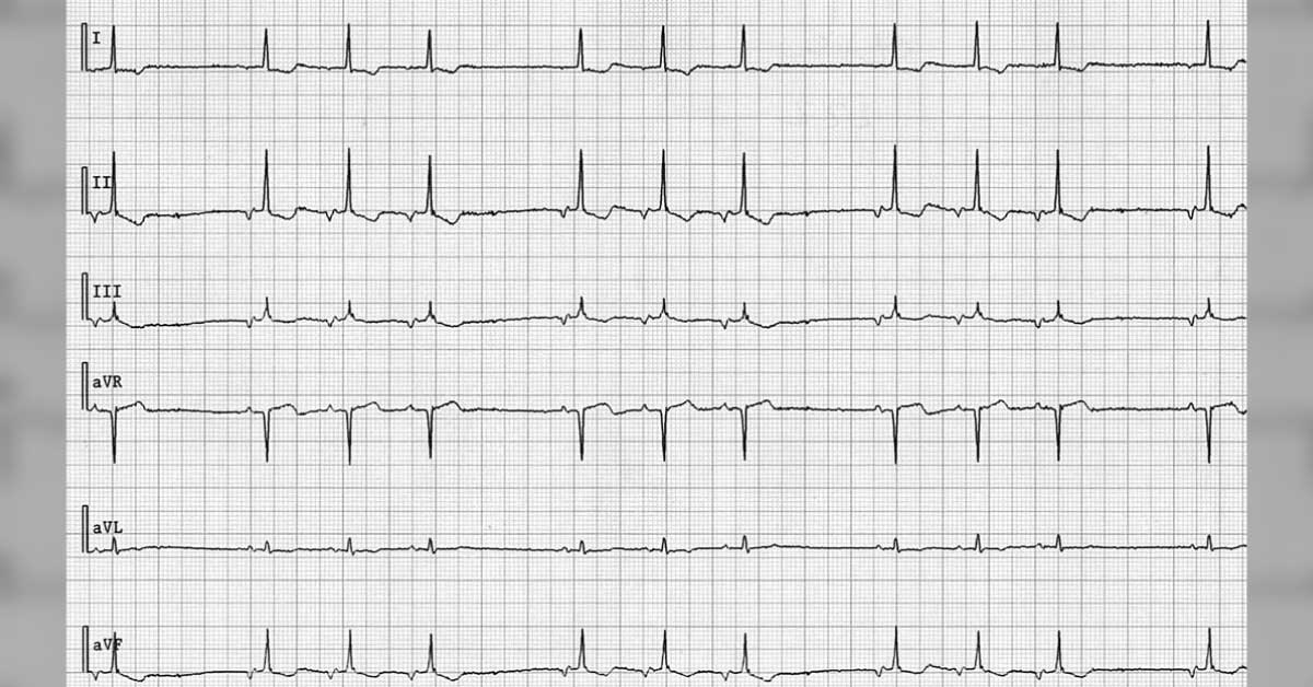 Irregular Heart Beat In A Female