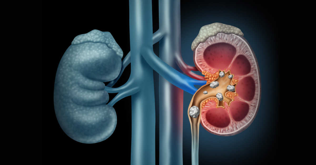 Moving Stones With Sound, New Ultrasound Technology Repositions Kidney Stones In People