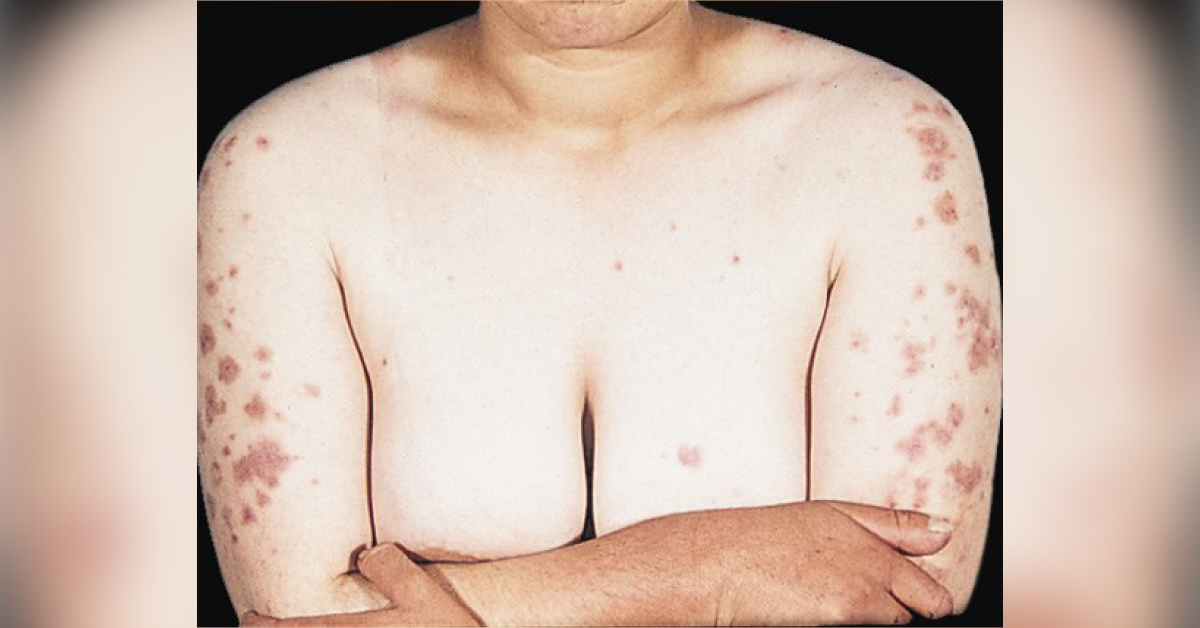 Tender Nodules On The Arms And Hands