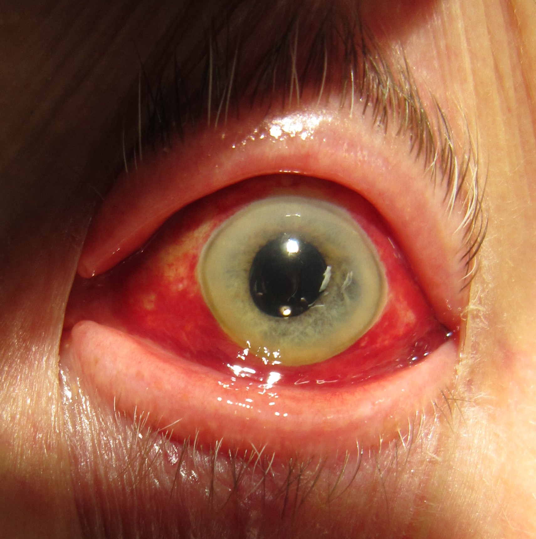 Brief Review On Subconjunctival Hemorrhage