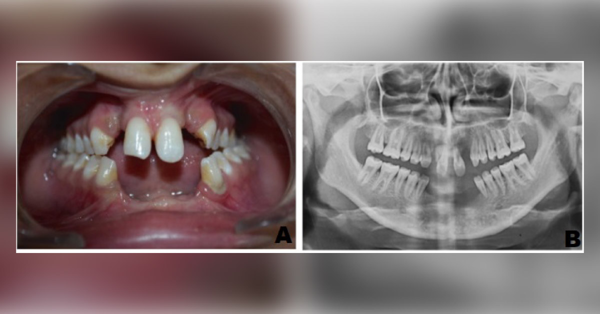 Can You Identify This Genetic Disorder?
