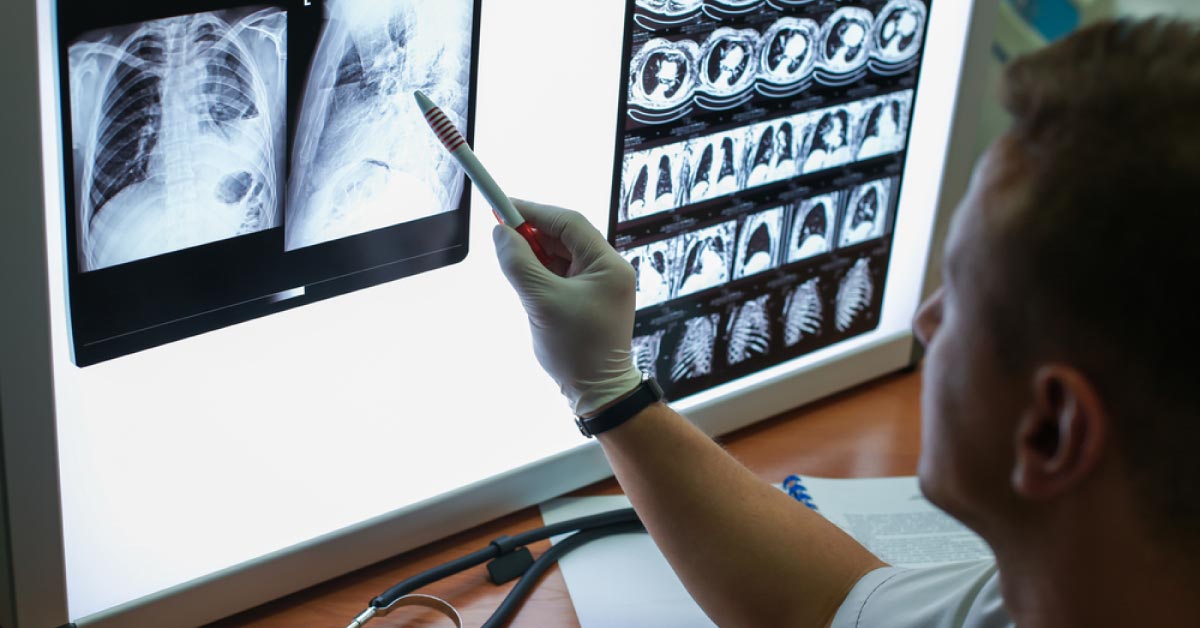 Vitamin D Boosting Immunity, Cures Tuberculosis Early