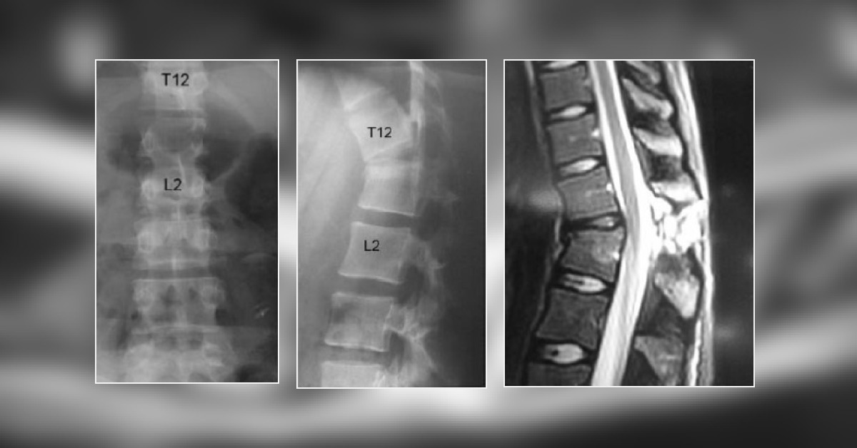How Would You Manage This Case of Spinal Trauma