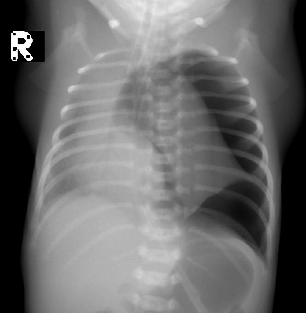 Case of a Neonate with Worsening Respiratory Distress
