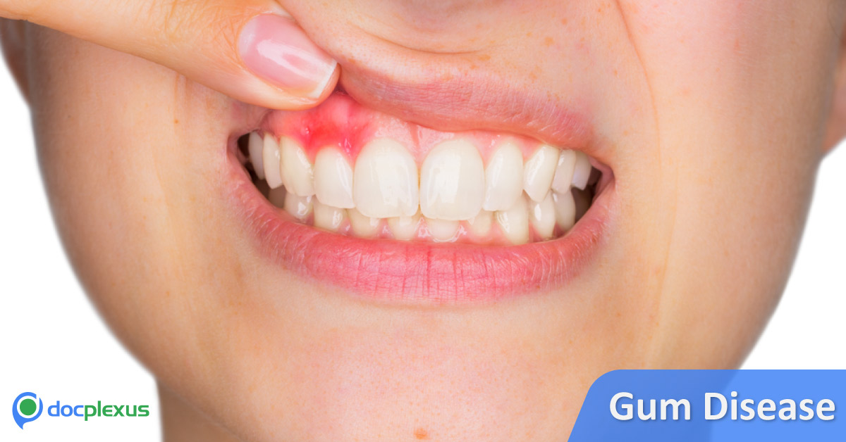 Untreated Gum Disease And Its Consequences