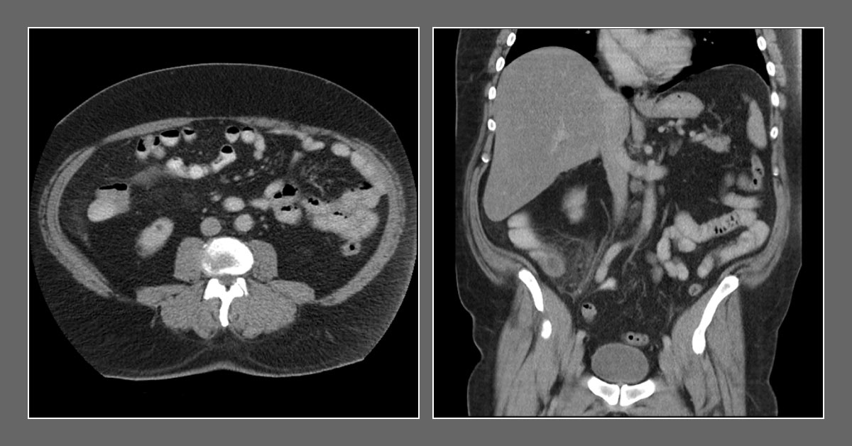 What Happened After Appendectomy?